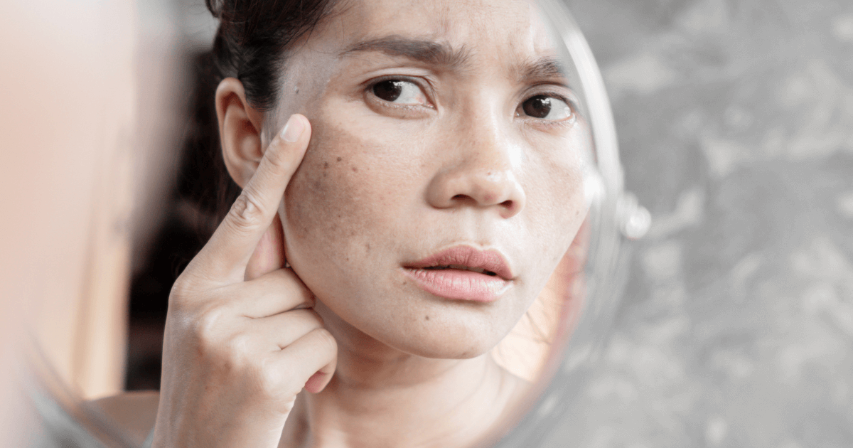hyperpigmentation - women in mirror